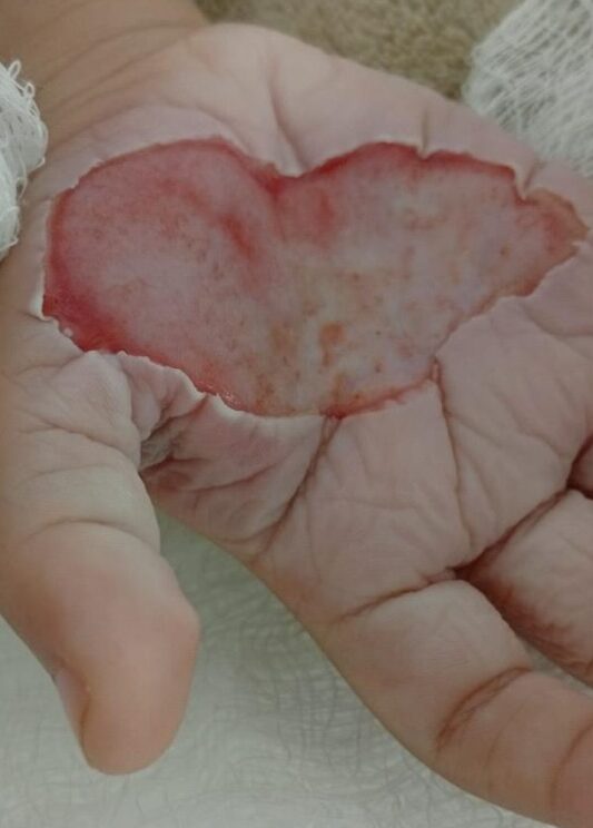 Madrasta que derreteu a mão de criança com colher quente é presa em Itapema: ‘pq sou louca’